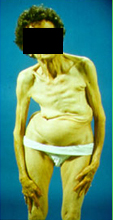 Photo: scoliosis in the elderly - patient image.