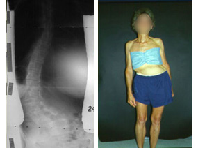 Image: X-ray and photo of a patient with adult degenerative scoliosis.