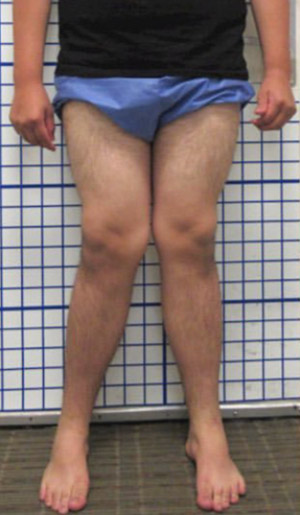 An adult with knock knees.