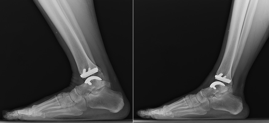 Ankle replacement X-rays showing flexion and extension.