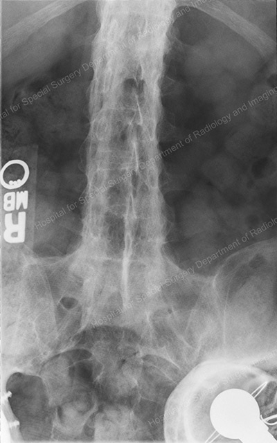 Frontal X-ray of an ankylosed spine in a patient with ankylosing spondylitis.