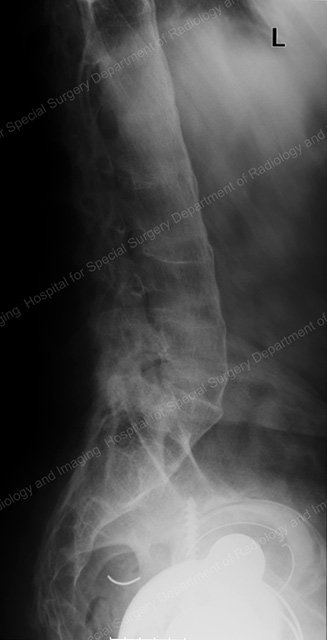 Side-view X-ray of an ankylosed spine in a patient with ankylosing spondylitis.