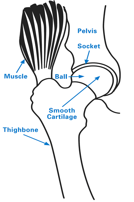 Illustration: anatomy of the hip joint showing the pelvis and femur, with the femoral head (ball) and acetabulum (socket) labeled