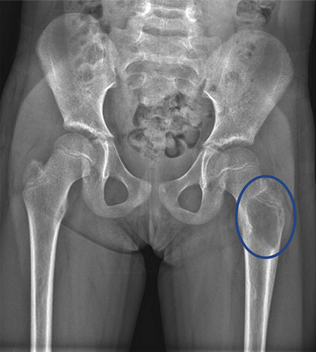 X-ray of benign bone tumor in upper thighbone of a six-year-old child.