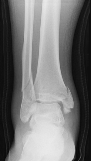 X-ray image showing front view of a bimalleolar fracture with mild displacement.