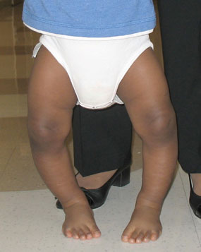 photo of a child with blount's disease and bow legs