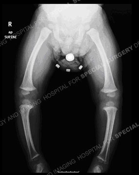 an x-ray of a child with blount's disease and bow legs