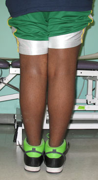 photo of the backs of a child with bow legs due to blount's disease after surgical treatment