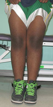 photo of the front of a child with bow legs due to blount's disease after surgical treatment