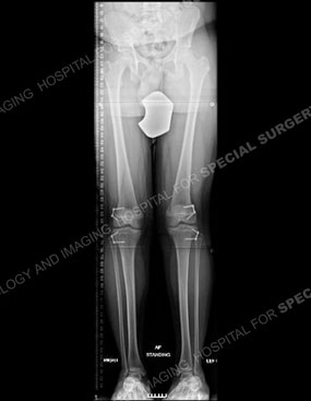 X-ray of a child with bowlegs due to Blount's disease after treatment