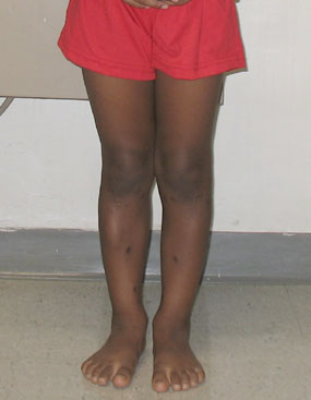 photo of the front of a child with blount's disease after a tibial osteotomy.