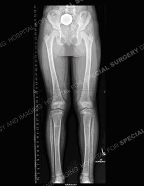 x-ray of a child with blount's disease after a tibial osteotomy.