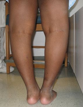 photo of the back of a child with bow legs due to blount's disease