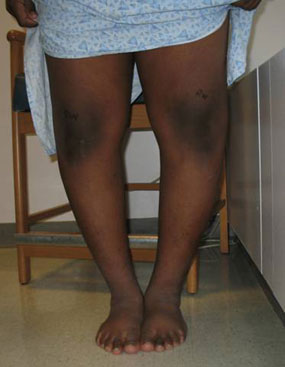 photo of the front of a child with bow legs due to blount's disease