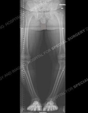 x-ray of a child with bow legs due to Blount's disease before treatment