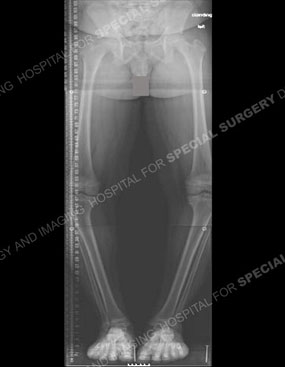 x-ray of a child with bow legs due to blount's disease before treatment