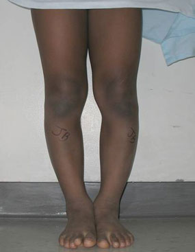 photo of the front of a child with blount's disease prior to a tibial osteotomy.