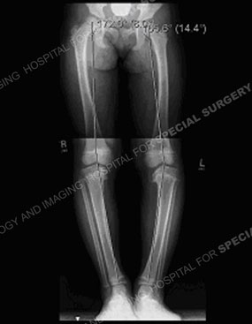 x-ray of the front of a child with blount's disease prior to a tibial osteotomy.