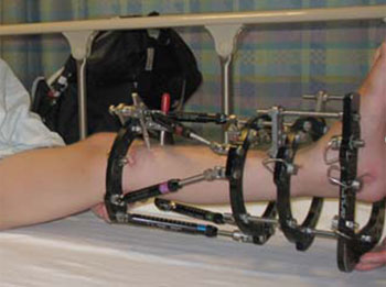 Photo of a child's leg in an external fixator