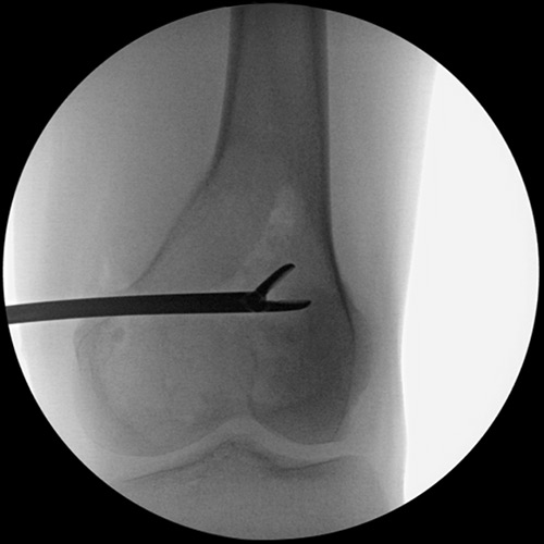 X-ray of a biopsy of a bone lesion.