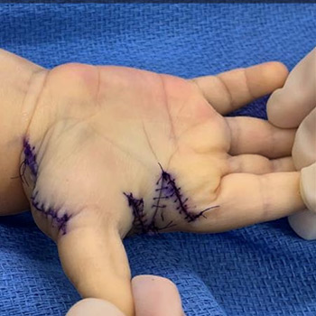 Postsurgical photo of preaxial polydactyly with the extra thumb surgically removed.