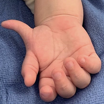 A polydactyly case of an extra thumb.