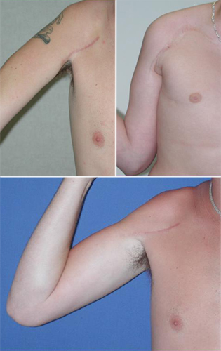 Image with 3 examples of postsurgical scarring after brachial plexus repair