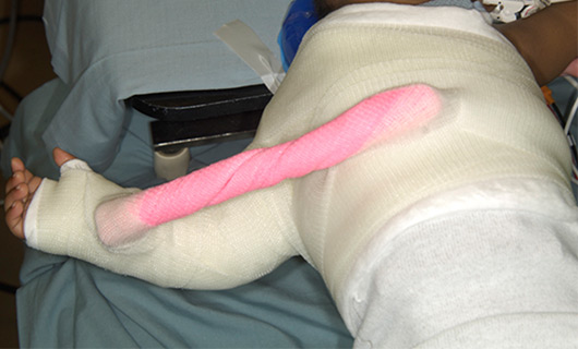 A child wearing an upper extremity spica cast.