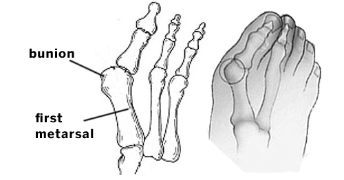 Illustrations of foot anatomy including a bunion and the first metarsal.