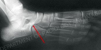Right foot demonstrating Calcaneonavicular Coalition - The red arrow indicates the coalition from an article about pediatric foot deformities