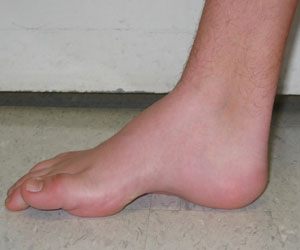 Pediatric Foot Deformities: An Overview