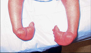 clubfoot with marked curvature of the foot, called a cavus deformity