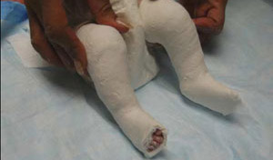 The Initial Ponseti Cast - Forefoot aligns with the heel, outer edge of foot tilts even further downward.
