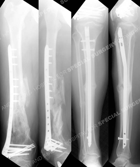Anteroposterior and lateral femur and tibia radiographs at 1 year illustrating healed distal femur and tibia fractures in excellent alignment.