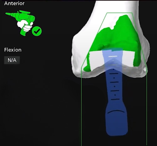 Computer navigation of robotic arm beginning incisions for osteotomy.
