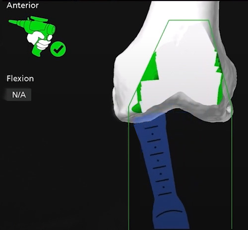 Computer navigation of a robotic arm near completion of the osteotomy.