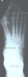 X-ray of a foot showing bunion