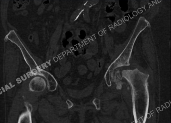 Image: CT scan of the hips showing osteoarthritis and subchondral fracture.
