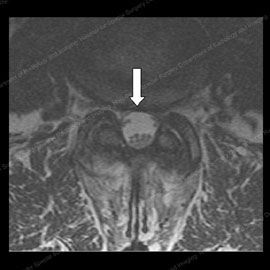MRI of the same patient after spine decompression surgery