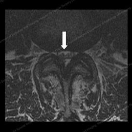 MRI of a patient prior to spine decompression surgery