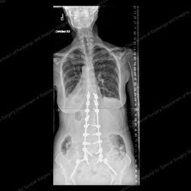 X-ray of the same patient after fusion surgery 