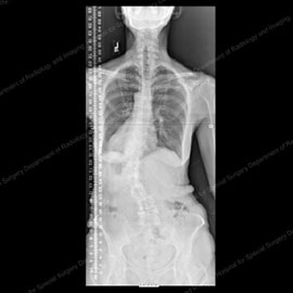 X-ray of a patient with degenerative scoliosis prior to surgery.