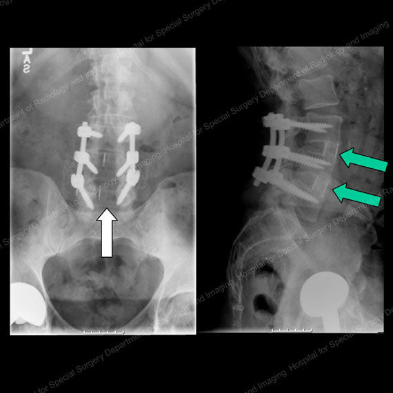 X-rays showing the same patient from the front (left) and side (right) one year after decompression and fusion surgery