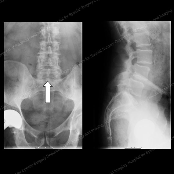 X-rays showing patient from the front (left) and side (right) prior to decompression and fusion surgery for stenosis and anterolisthesis.