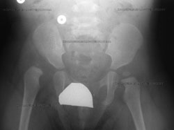 Pre-op X-ray of a child with hip dysplasia at Hospital for Special Surgery
