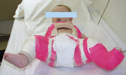 Following closed reduction, patient wears spica body cast. Pediatric Hip Dysplasia