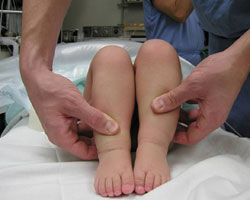 Preoperative right hip dislocation – right leg appears short. Pediatric Hip Dysplasia