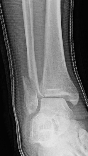 X-ray image showing front view of a displaced fibula with medial clear space widening (asymmetry of the joint space) indicating a deltoid ligament disruption.