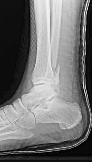 X-ray image showing side view of a displaced fibula fracture with a posterior malleolar fracture.