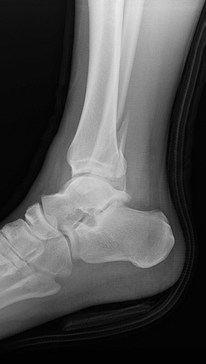 X-ray image showing side view of a displaced lateral malleolus fracture of the right foot.